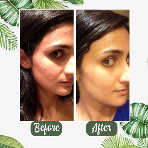 PurifyMist™ — Unleash Clear, Radiant Skin That Glows with Confidence - Image 4